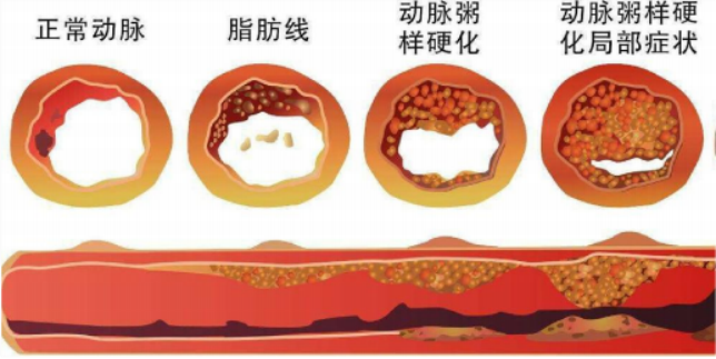 （挂网稿）真相之“软化血管521.png