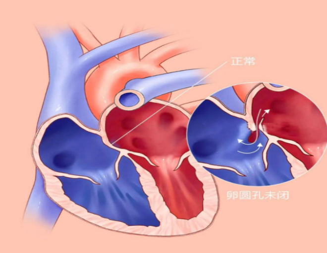 （挂网稿）卵圆孔未闭封堵术996.png